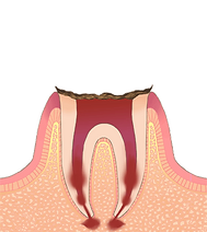 C4 歯の根まで進行した虫歯