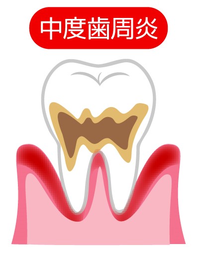 中度歯周病